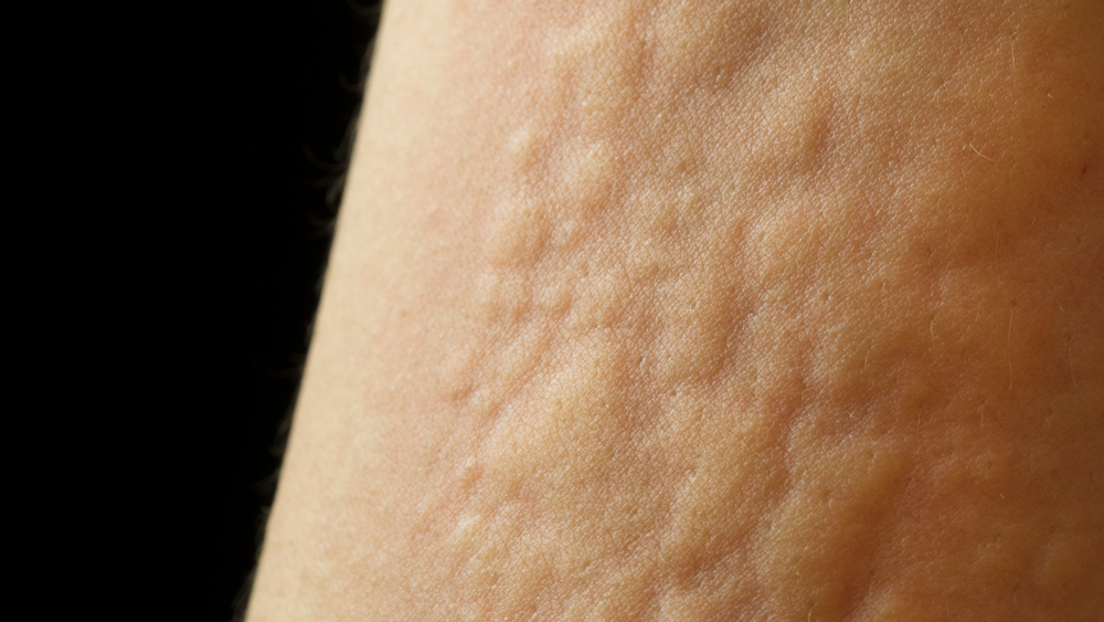 Hives
