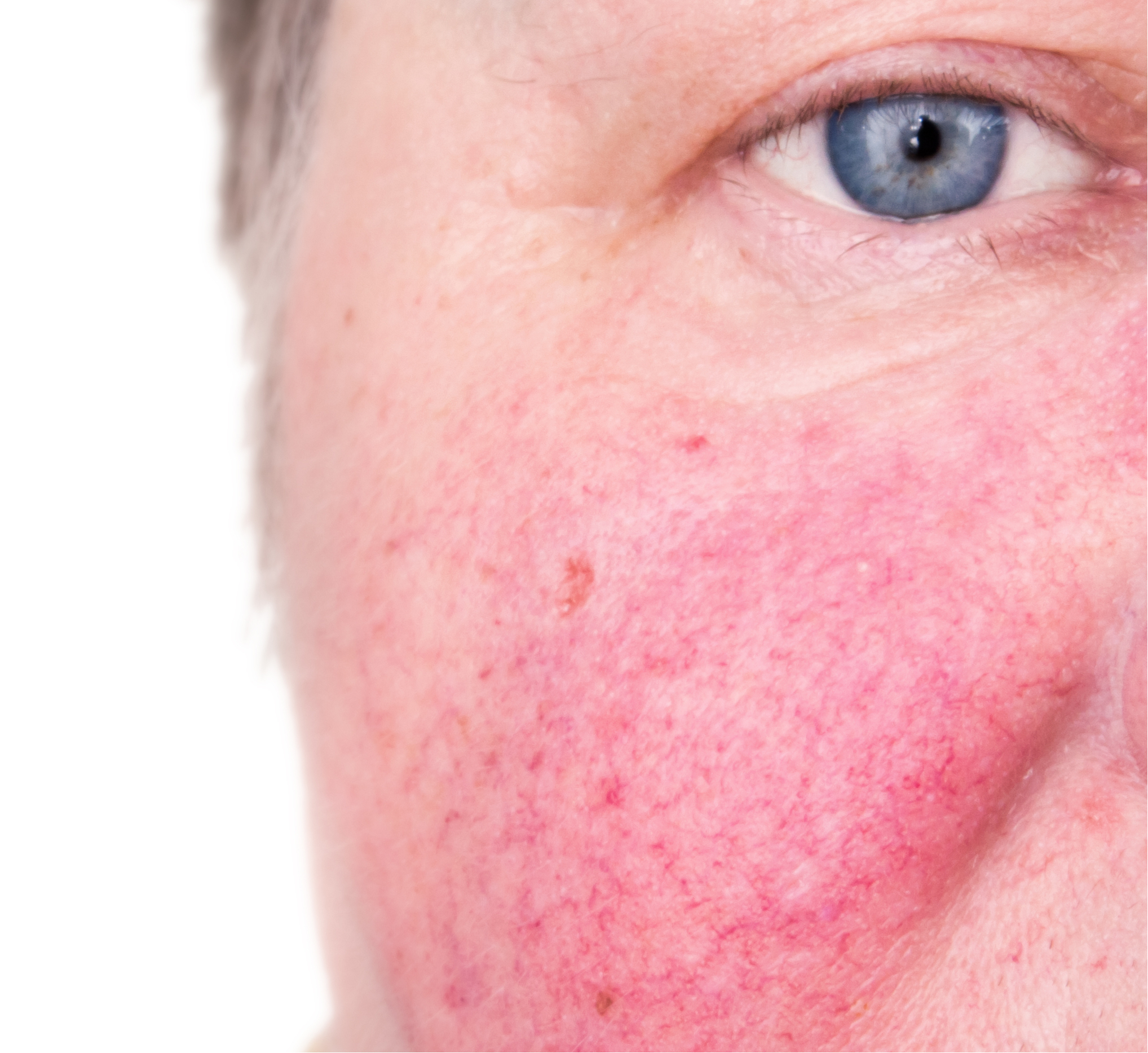 Rosacea